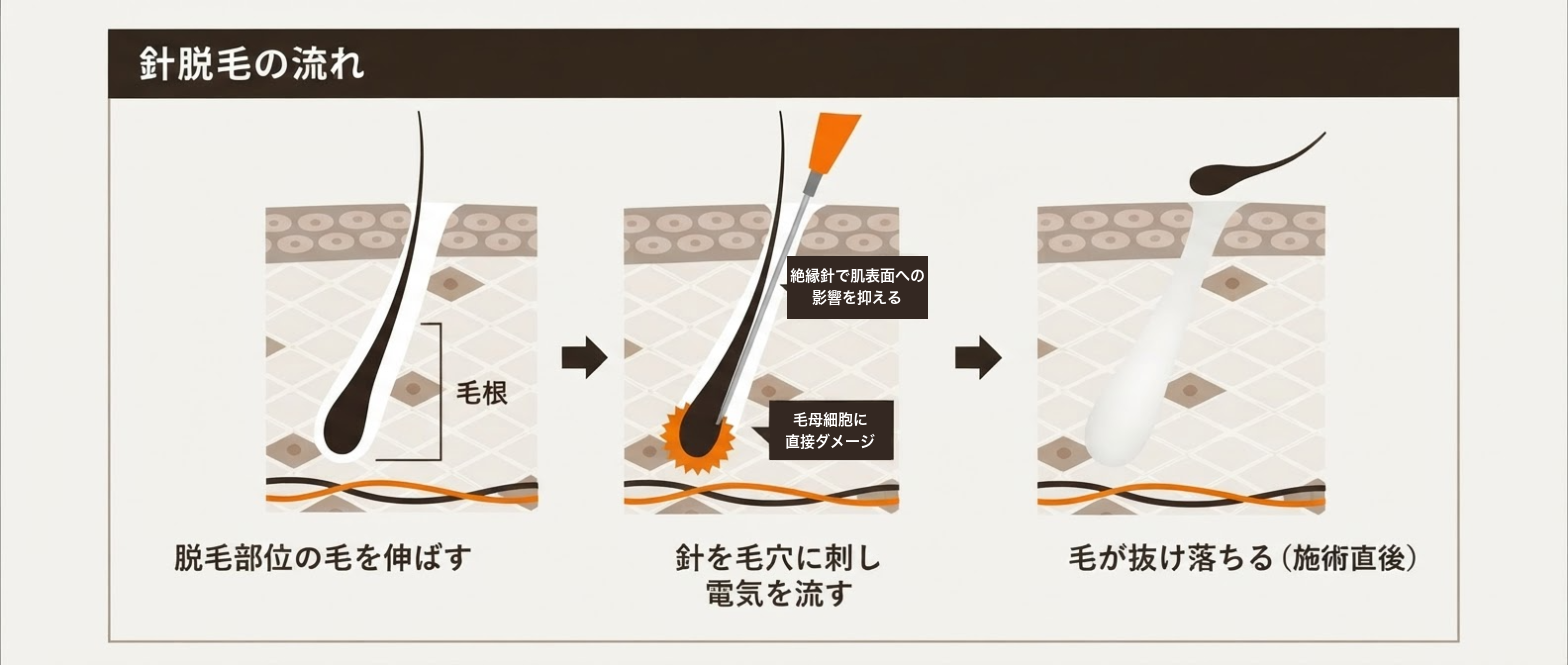 針脱毛の流れ(イメージ)
